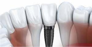 La tecnología de los implantes dentales